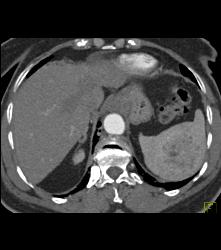 Splenic Hamartoma - CTisus CT Scan