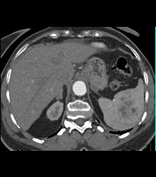 Splenic Hamartoma - CTisus CT Scan