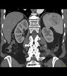 Splenic Hamartoma - CTisus CT Scan