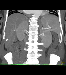 Splenic Hamartoma - CTisus CT Scan