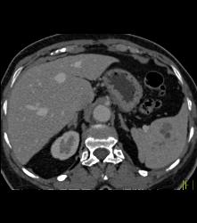 Hemangioma - CTisus CT Scan