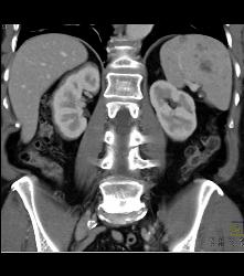 Hemangioma - CTisus CT Scan