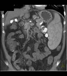 Splenomegaly With Nodes - CTisus CT Scan