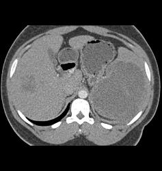 Lymphoma Involves Liver and Spleen - CTisus CT Scan