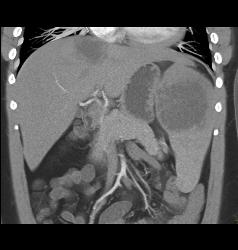 Lymphoma Involves Liver and Spleen - CTisus CT Scan