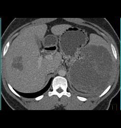 Lymphoma Involves Liver and Spleen - CTisus CT Scan