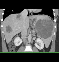 Lymphoma Involves Liver and Spleen - CTisus CT Scan