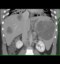 Lymphoma Involves Liver and Spleen - CTisus CT Scan