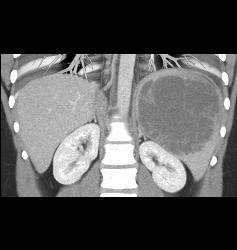 Lymphoma Involves Liver and Spleen - CTisus CT Scan