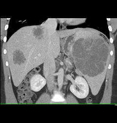 Lymphoma Involves Liver and Spleen - CTisus CT Scan