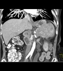 Pancreatic Cancer Invades the Spleen - CTisus CT Scan