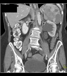 Pancreatic Cancer Invades the Spleen - CTisus CT Scan