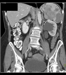 Pancreatic Cancer Invades the Spleen - CTisus CT Scan