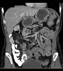 Pancreatic Cancer Invades the Spleen - CTisus CT Scan