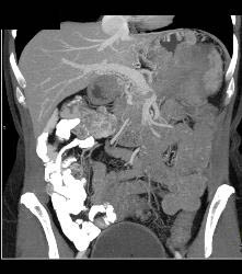 Pancreatic Cancer Invades the Spleen - CTisus CT Scan