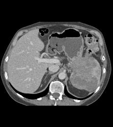 Pancreatic Cancer Invades the Spleen - CTisus CT Scan