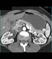 Splenule in Splenic Hilum - CTisus CT Scan