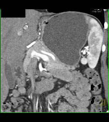 Splenule in Splenic Hilum - CTisus CT Scan