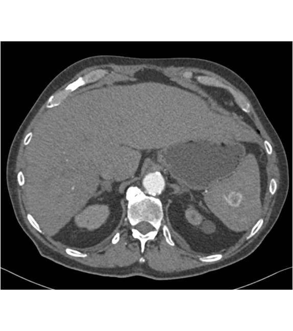 Splenic Hemangioma - CTisus CT Scan