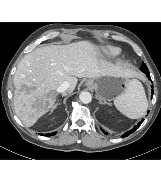 Cholangiocarcinoma with Splenic Hemangioma - CTisus CT Scan