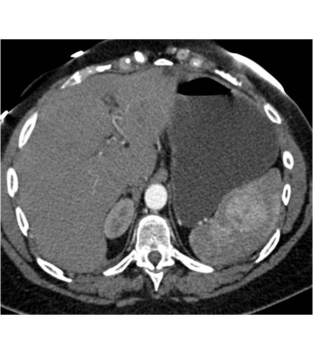 Splenic Hemangioma - CTisus CT Scan