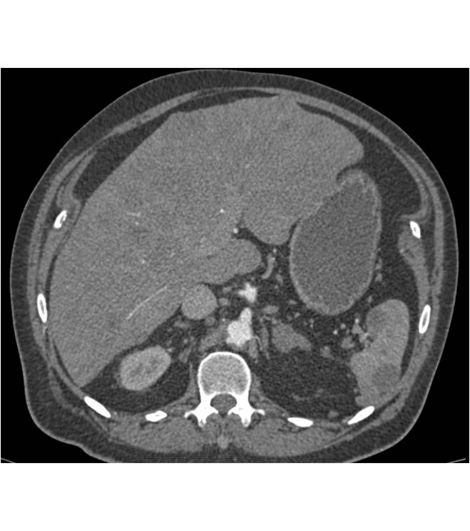 Melanoma Metastatic to Liver and Spleen - CTisus CT Scan