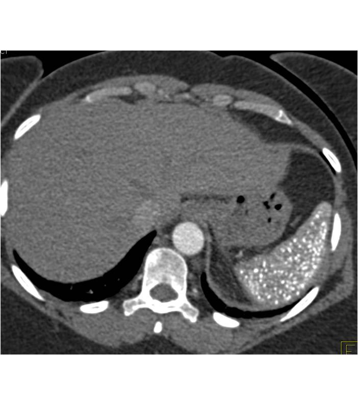 Splenic Granulomatous Disease - CTisus CT Scan