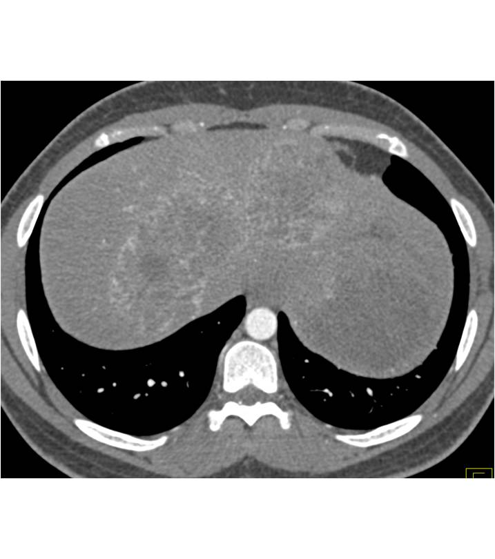 Neuroendocrine Tumor Metastatic to the liver and Spleen - CTisus CT Scan