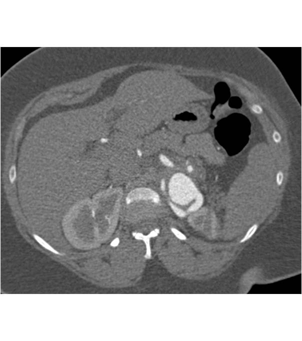 Splenic Artery Aneurysm - CTisus CT Scan