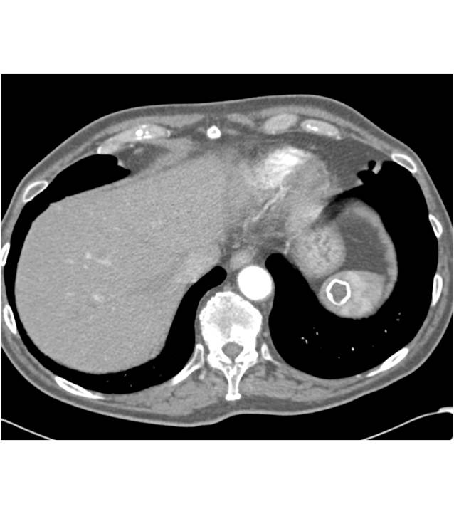 Calcified Splenic Cyst - CTisus CT Scan