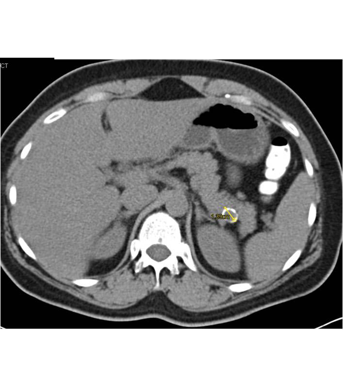 Splenic Artery Aneurysm - CTisus CT Scan