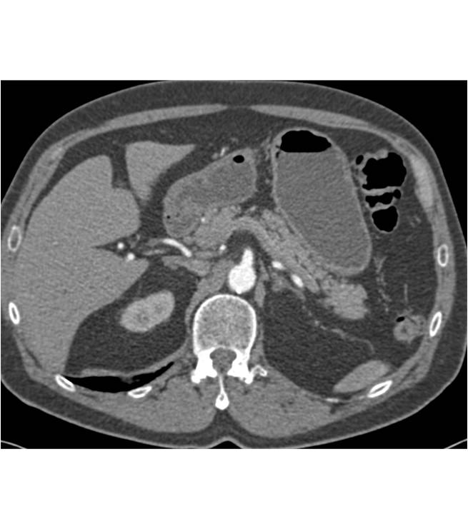 Accessory Spleen Simulates an Islet Cell Tumor in the Tail of the Pancreas - CTisus CT Scan