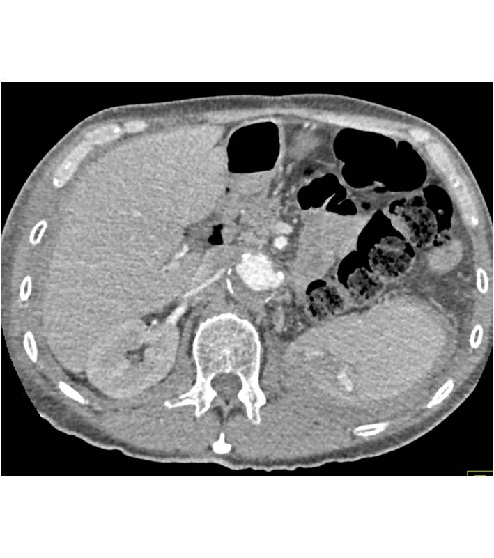 Splenic Infarct - CTisus CT Scan