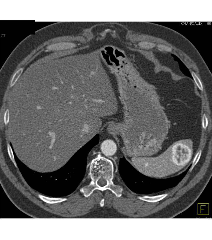 Metastatic Renal Cell Carcinoma to the Spleen - CTisus CT Scan