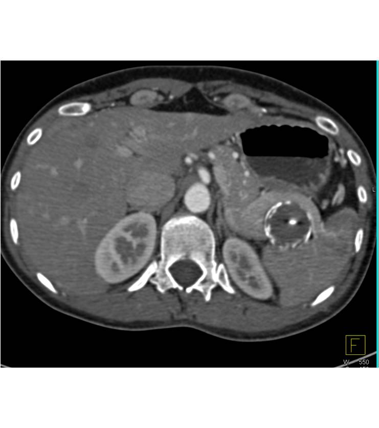 Splenic Artery Aneurysm with Embolization - CTisus CT Scan