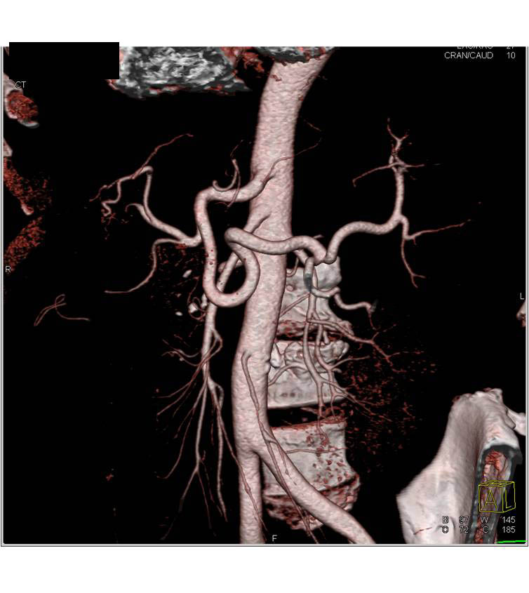 Cirrhosis and Varices with Portal Hypertension - CTisus CT Scan