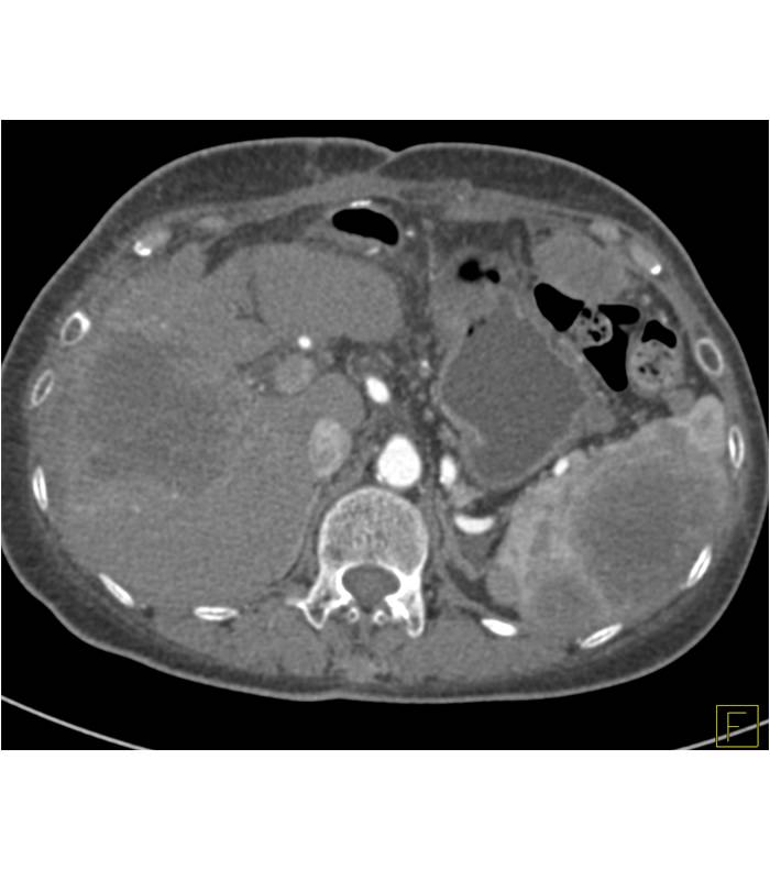 Metastatic Melanoma to the Liver and Spleen - CTisus CT Scan