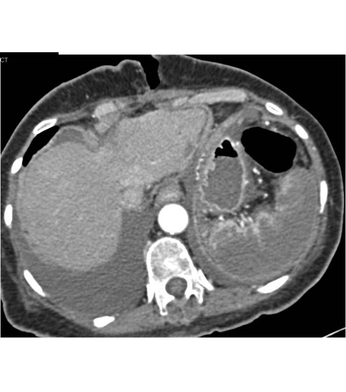 Splenic Infarcts-Global - CTisus CT Scan