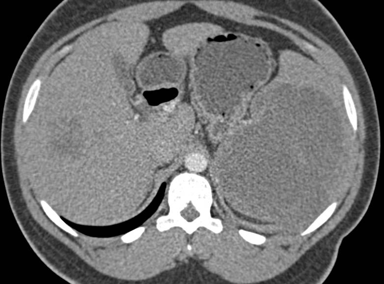 Lymphoma Involving the Liver and Spleen - CTisus CT Scan