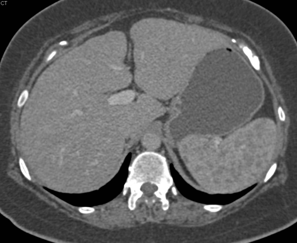 Sarcoidosis of the Spleen as well as Dilated Pancreatic Duct - CTisus CT Scan