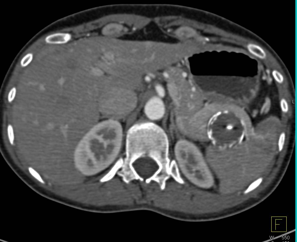 Splenic Artery Aneurysm s/p Embolization - CTisus CT Scan