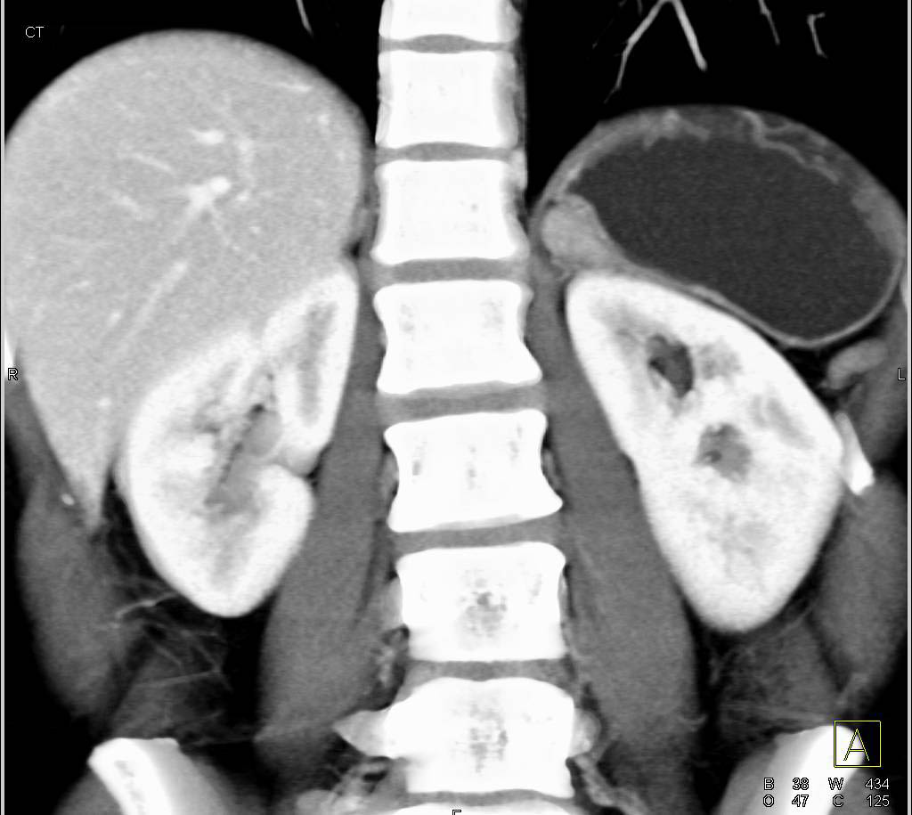 Accessory Spleen Simulates Recurrence - CTisus CT Scan