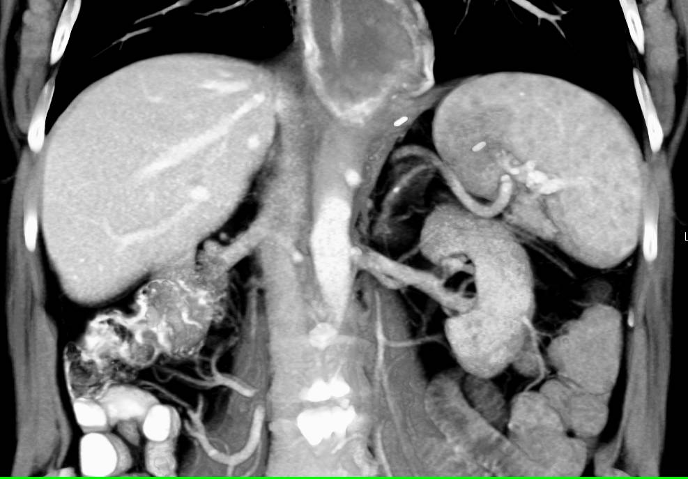 Sarcoidosis of the Spleen - CTisus CT Scan