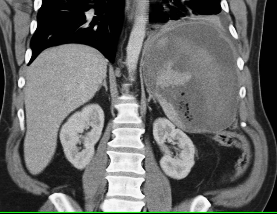 Splenic Infarct and Bleed - CTisus CT Scan