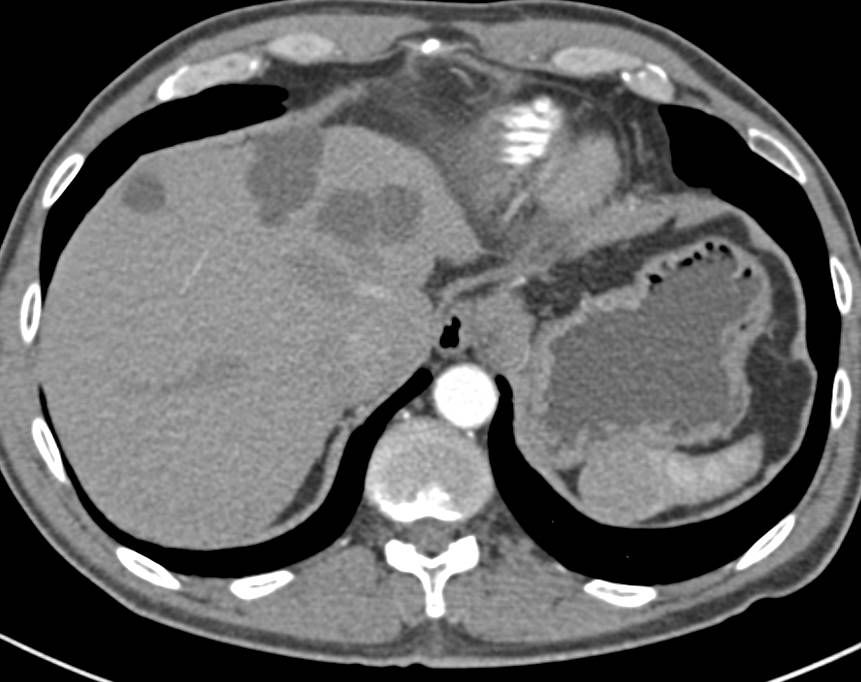 Splenic Hemangioma and Complex Right Renal Cyst - CTisus CT Scan