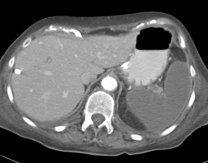 Global Splenic Infarct in a Patient with a Liver Abscess - CTisus CT Scan