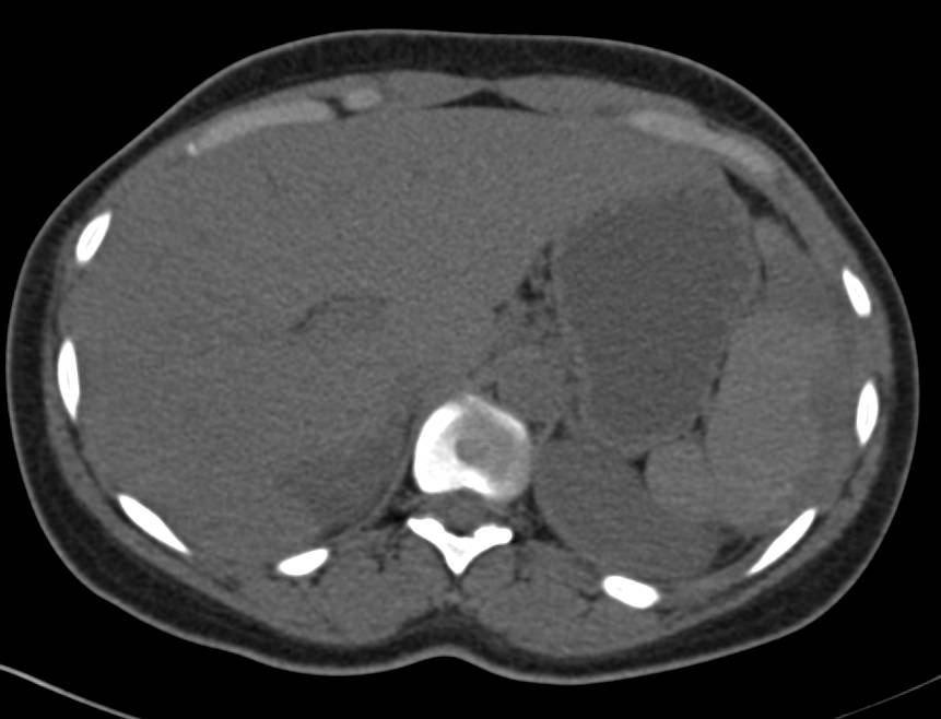 Pseudomyxoma Peritonei (PMP) with Implants on Spleen - CTisus CT Scan