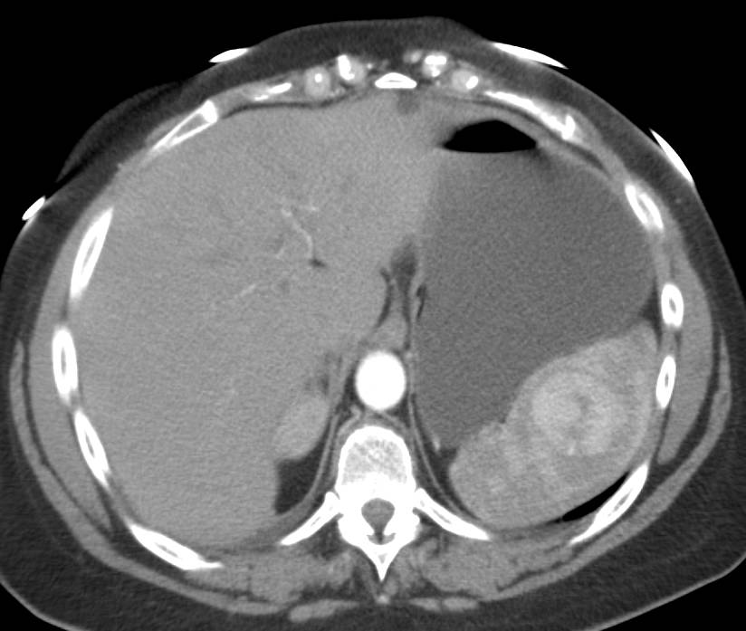 Splenic Hamartoma - CTisus CT Scan