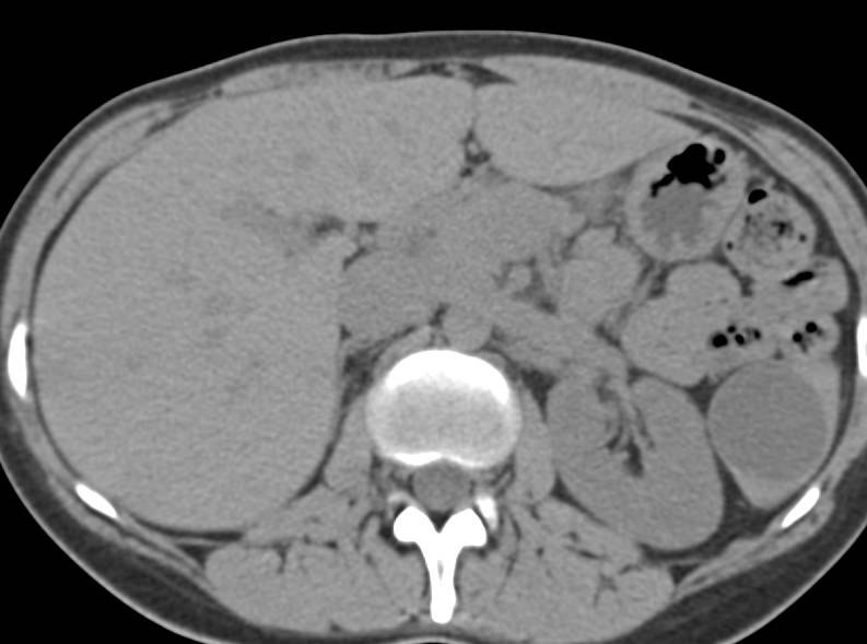 Splenic Cyst - CTisus CT Scan