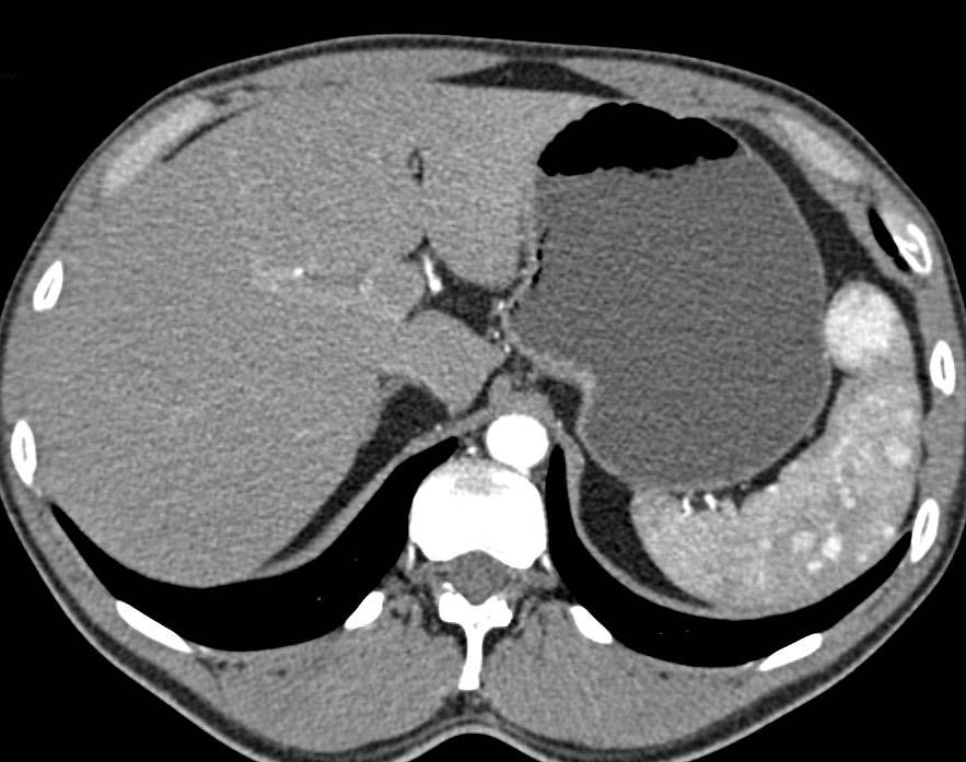 Multiple Splenic Hemangiomas - CTisus CT Scan